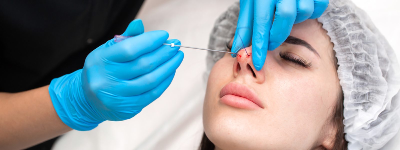 Cosmetic,Procedure,For,Non-surgical,Rhinoplasty.,The,Beautician,Inserts,Cosmetic,Threads