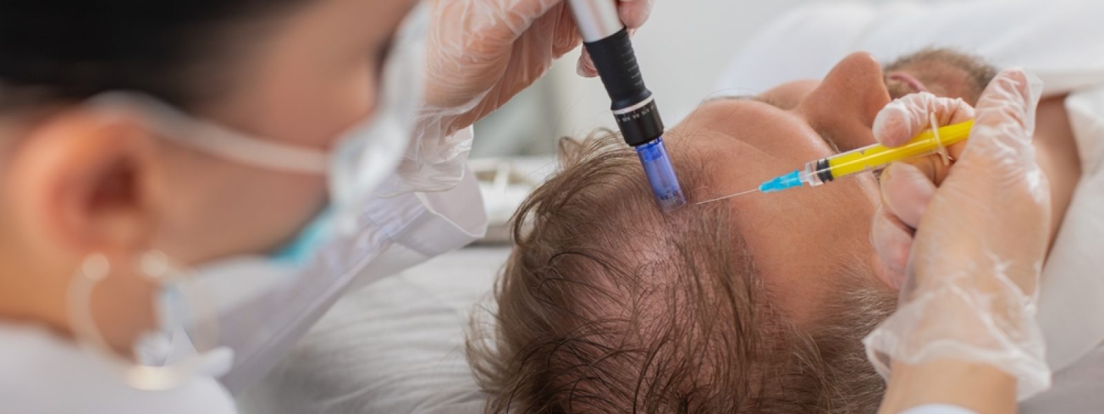 Alopecia.,Man,Hair,Loss,Improve,Growth,Treatment,Regeneration,,Dermapen,Microneedling,