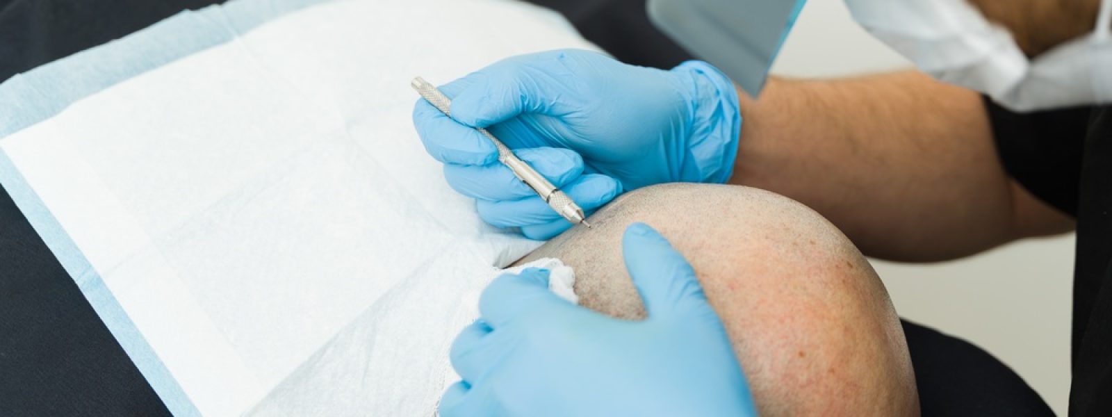 Hair,Transplant,Procedure,On,A,Man's,Scalp,,Doctor,Performing,Hair